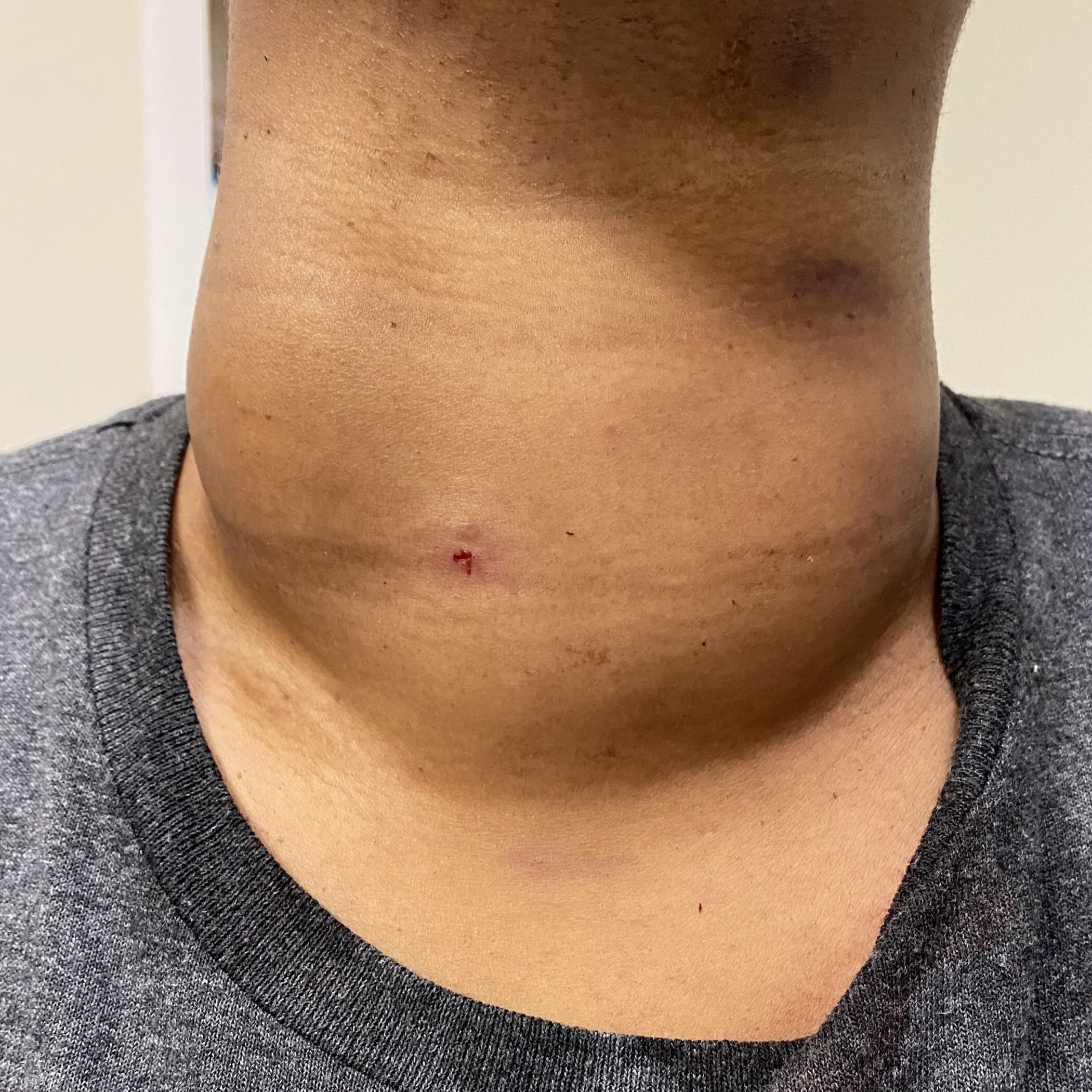 Immediately after her RFA